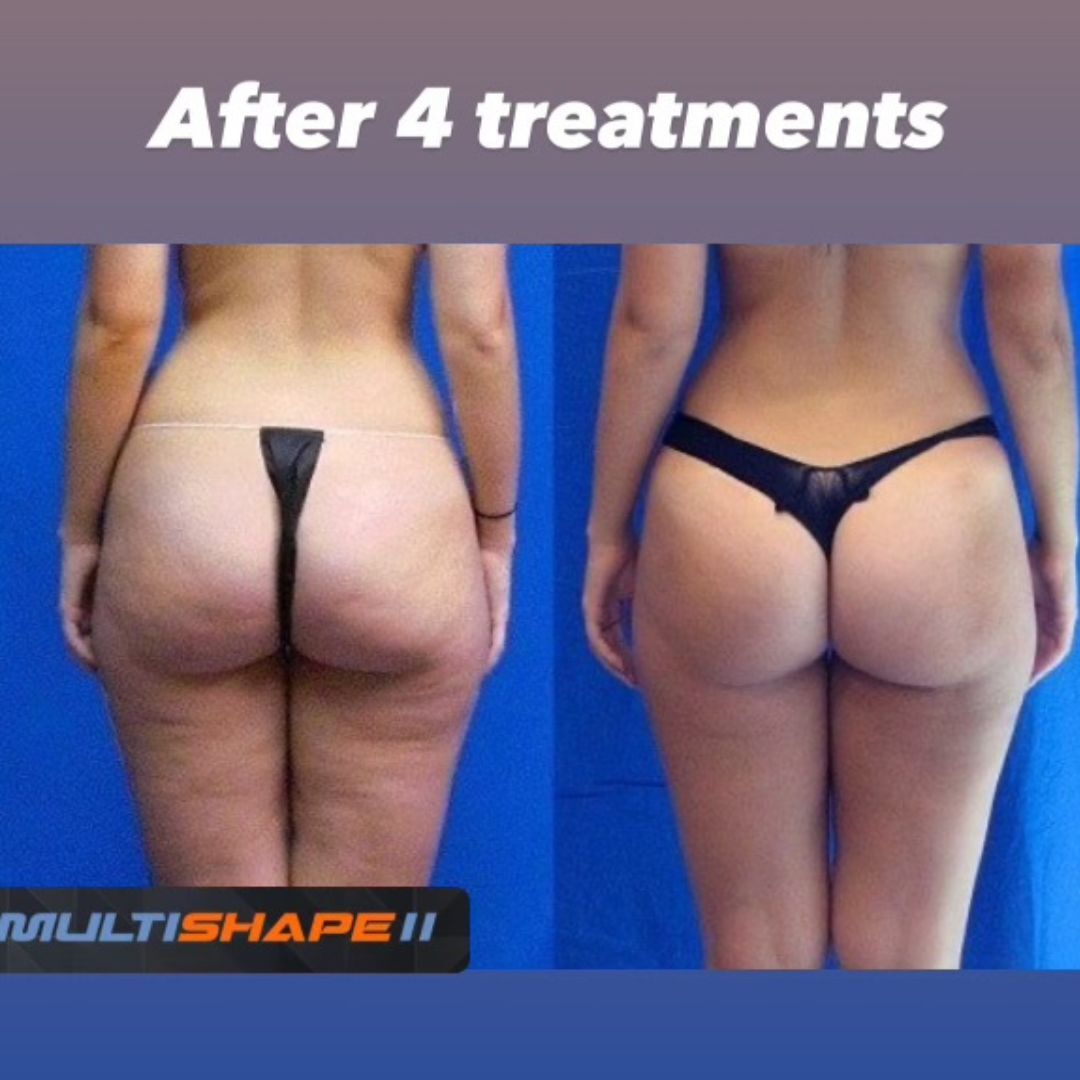 Advanced Body Sculpting in Gainesville, FL | Multishape 2 - Elite  Esthetics™ Gainesville FL